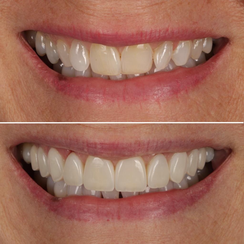 Composite Bonding