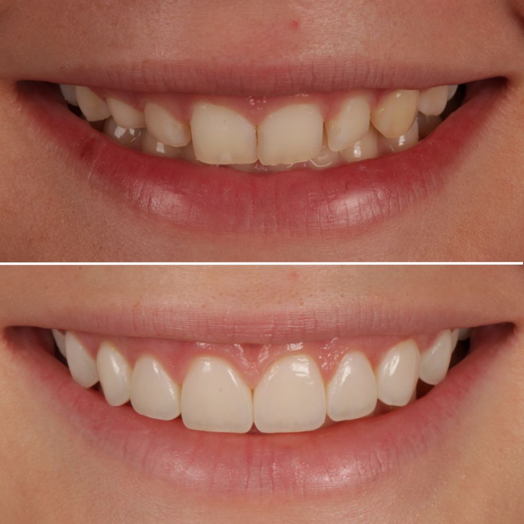 Composite Bonding
