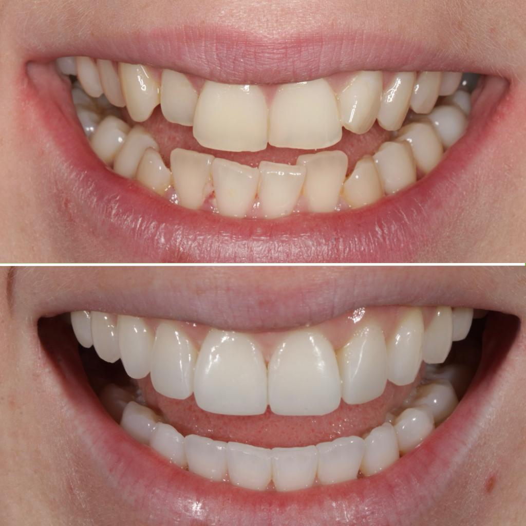 Invisalign/Composite Bonding